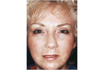 Fotoringiovanimento del viso (Laser Resurfacing), caso 3, post-intervento