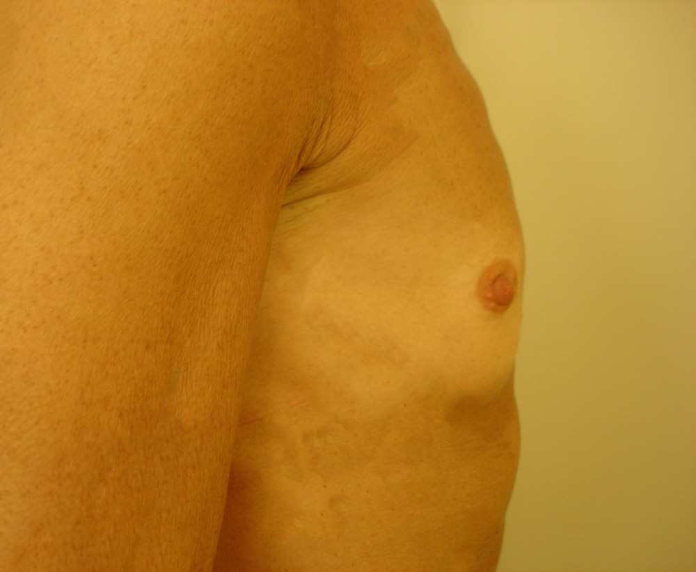 Mastoplastica Additiva, Caso 05, profilo dx, pre-intervento
