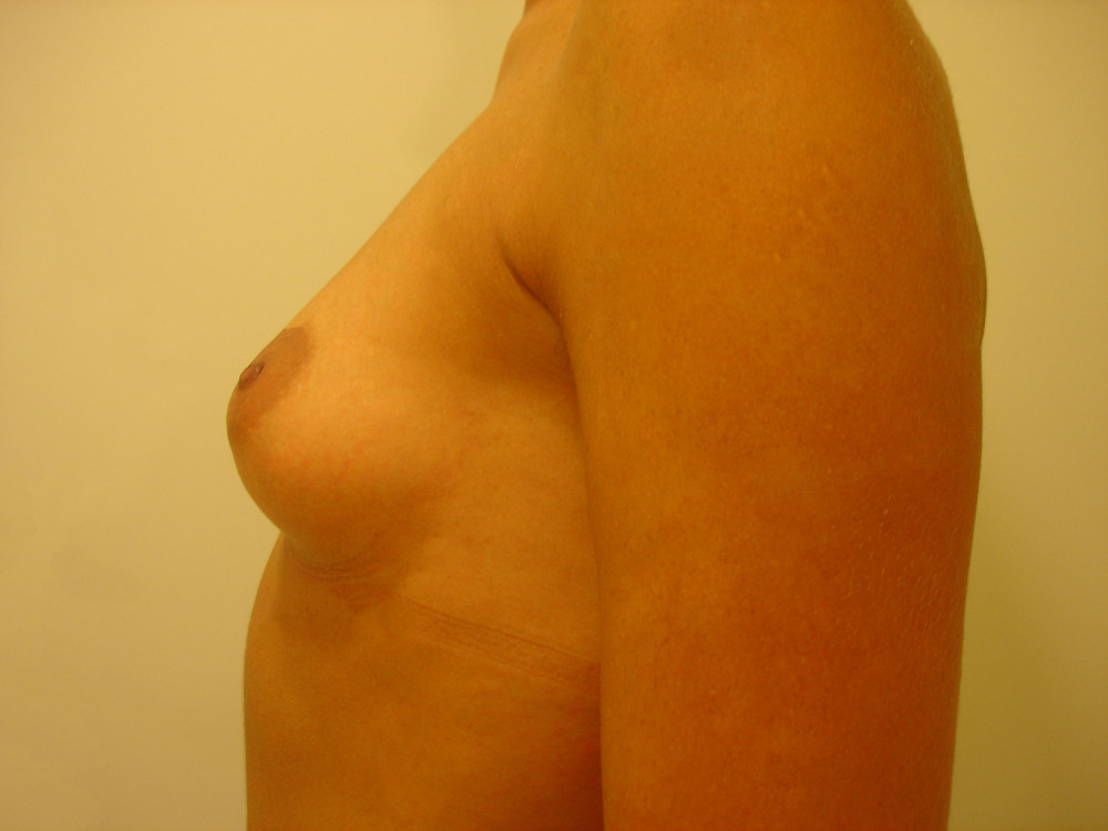 Mastoplastica Additiva, Caso 11, profilo sx, pre-intervento