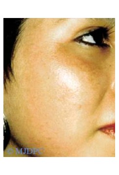 Biorivitalizzazione del volto con acido ialuronico, caso 01, post-intervento