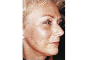 Fotoringiovanimento del viso (Laser Resurfacing), caso 2, pre-intervento