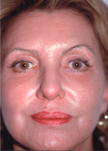 Fotoringiovanimento del viso (Laser Resurfacing), caso 5, post-intervento