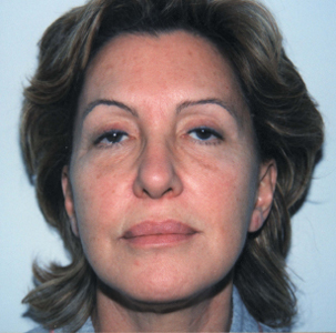 Fotoringiovanimento del viso (Laser Resurfacing), caso 5, pre-intervento
