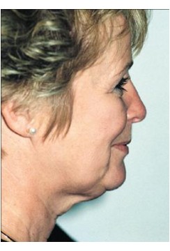 Lifting viso collo, caso 2, pre-intervento