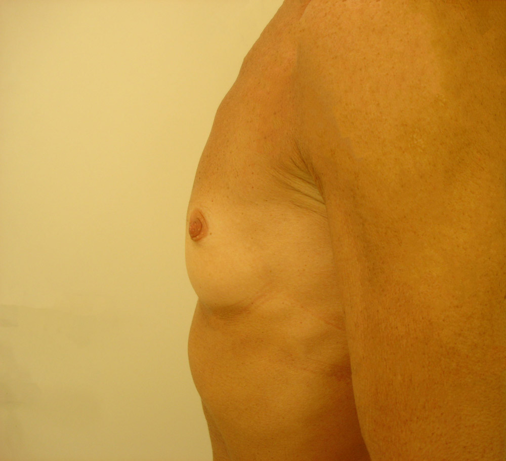 Mastoplastica Additiva, Caso 05, profilo sx, pre-intervento
