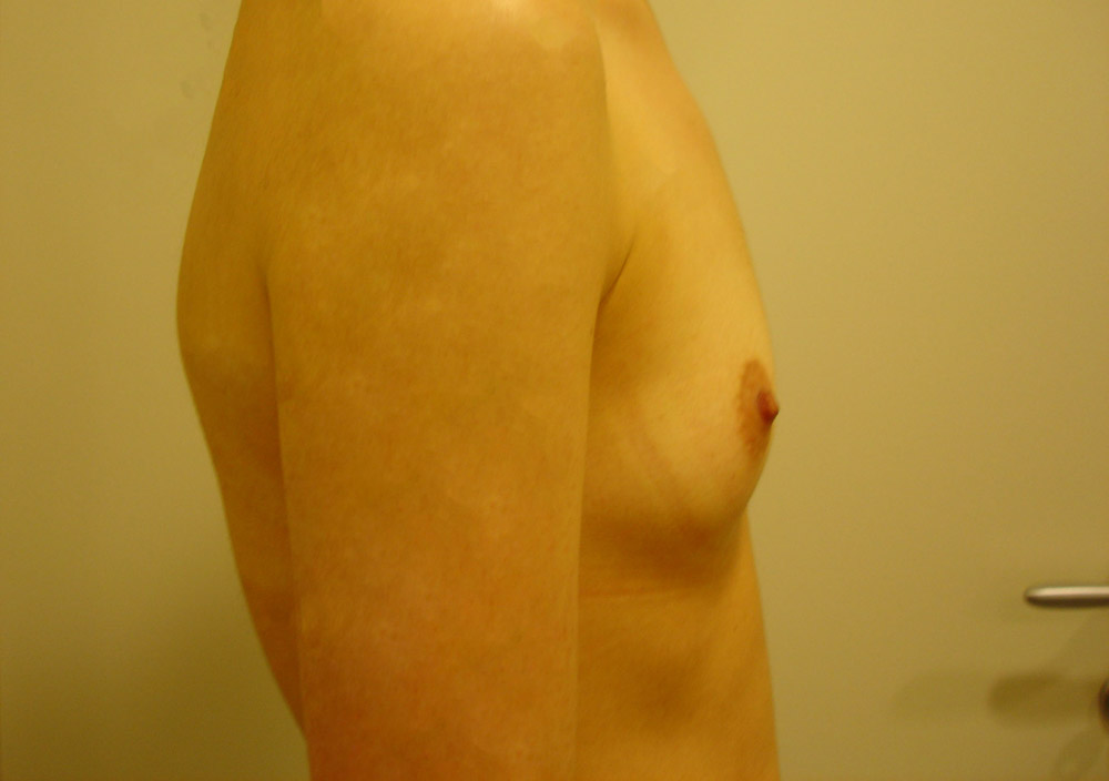 Mastoplastica Additiva, Caso 06, profilo dx, pre-intervento
