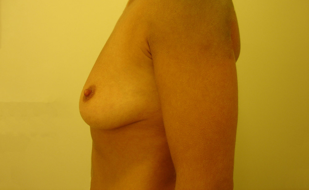 Mastoplastica Additiva, Caso 08, profilo sx, pre-intervento