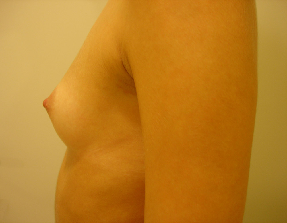 Mastoplastica Additiva, Caso 14, profilo sx, pre-intervento